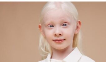 ЖИВОТОТ НА АЛБИНОСИТЕ- МИТОВИ И РЕШЕНИЈА